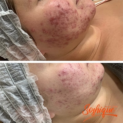 Chemical Peel Acne Malta before & After 1