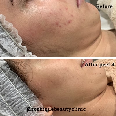 Chemical Peel Acne Malta before & After 2