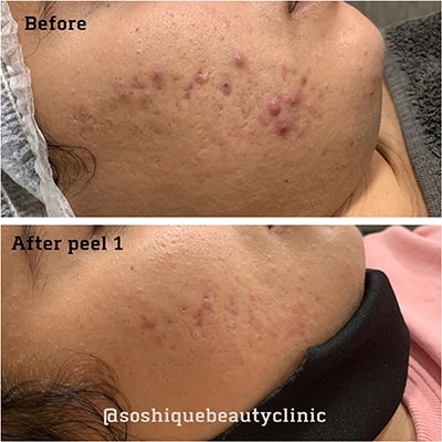 Chemical Peel Acne Malta before & After 3