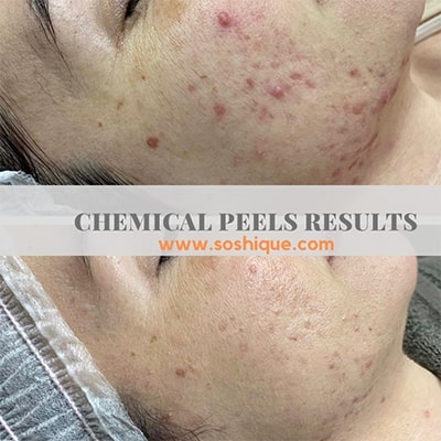 Chemical Peel Acne Malta before & After 4