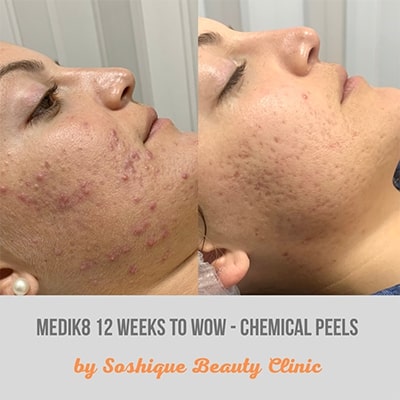 Chemical Peel Acne Malta before & After 5