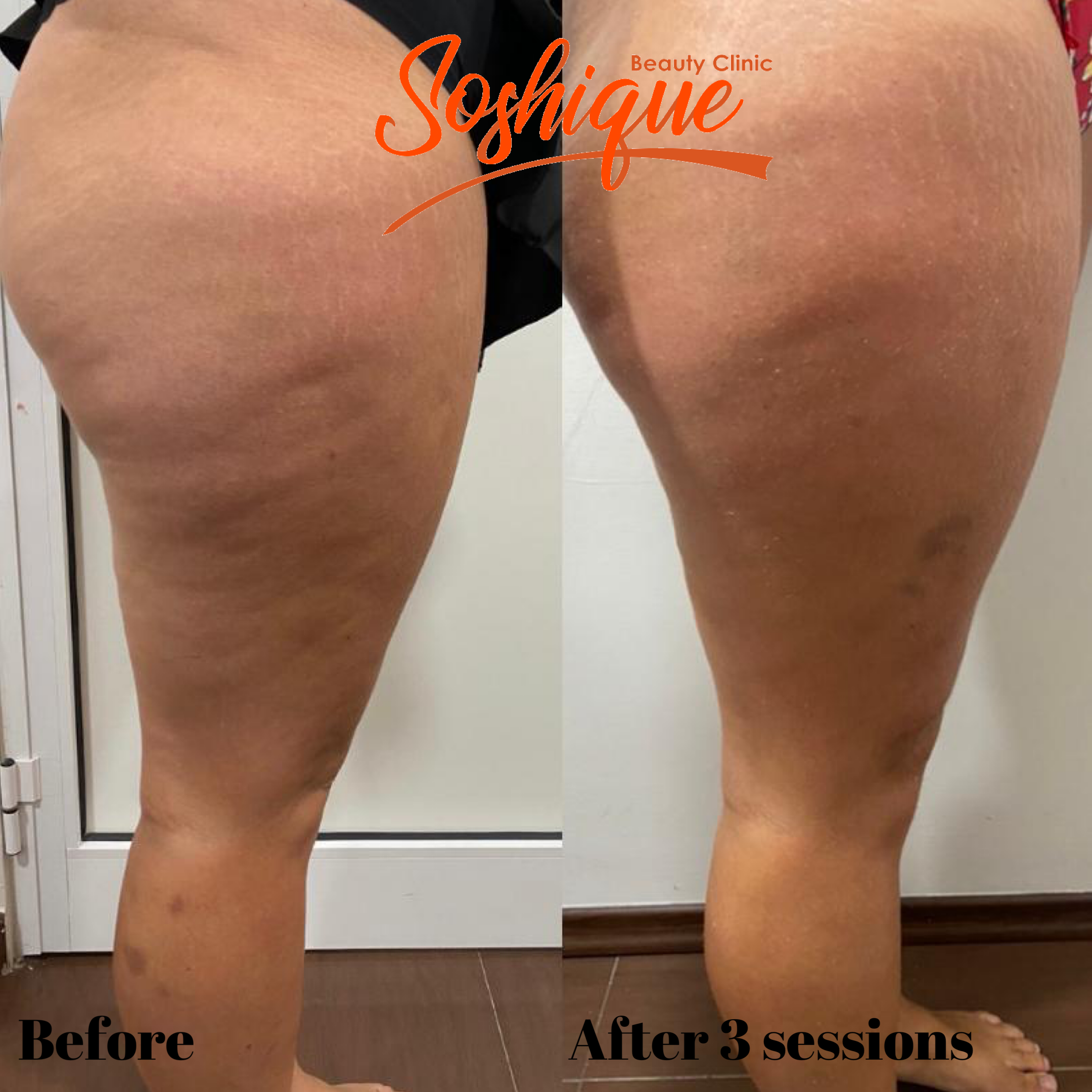 Anti-Cellulite Treatment 