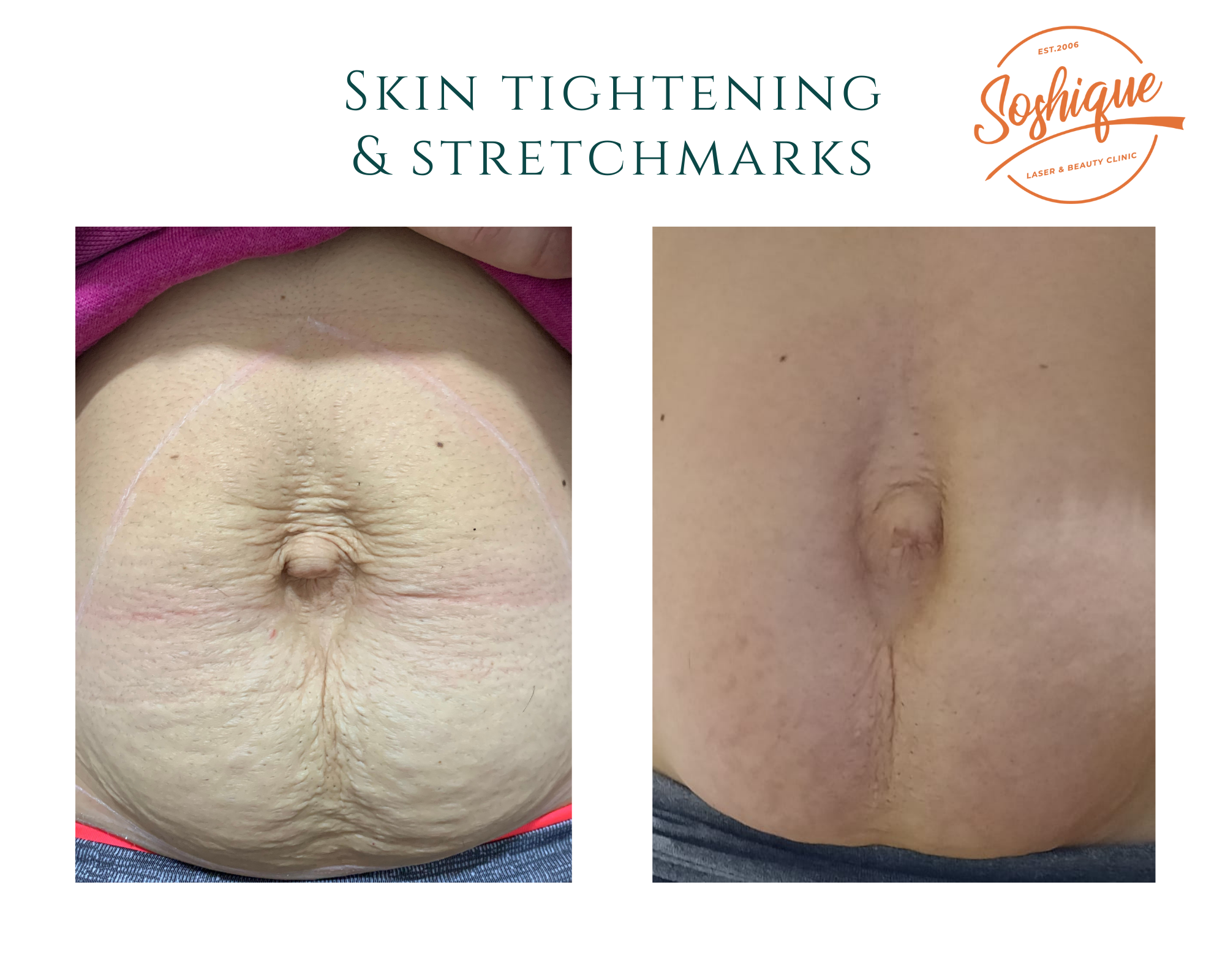 Read more about the article Skin Tightening & Stretchmarks