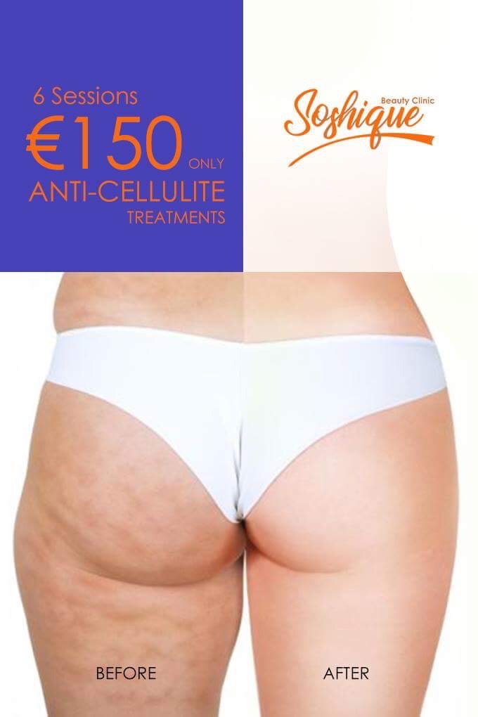 Read more about the article Anti Cellulite Treatments – Eur150